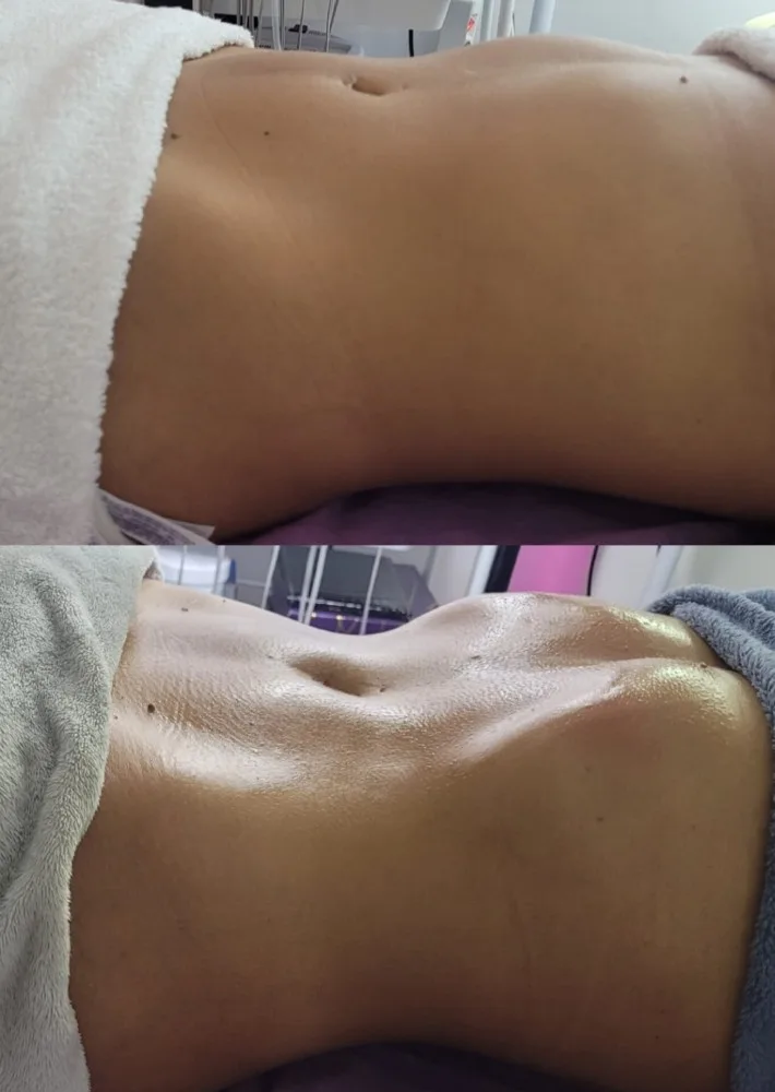 antes y despues anabella estetica brazil