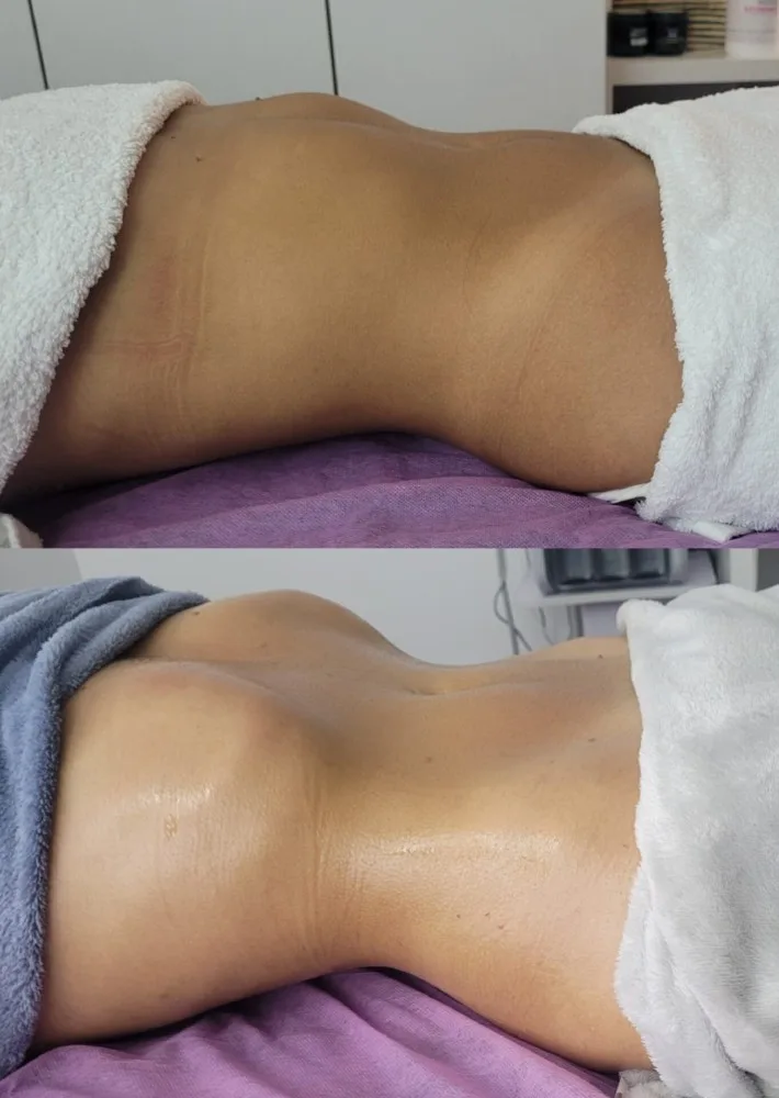 drenaje linfatico corporal anabella estetica brazil